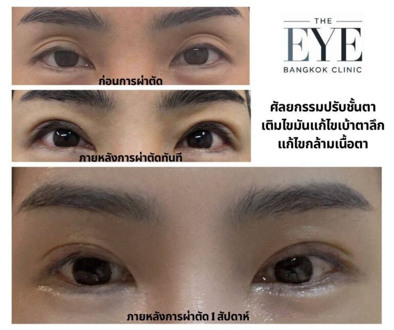 ผ่าตัดแก้ไขหนังตาตก คือการผ่าตัดกล้ามเนื้อตาส่วนไหน? รู้จัก ‘ลีเวเตอร์’ และ ‘มูลเลอร์’