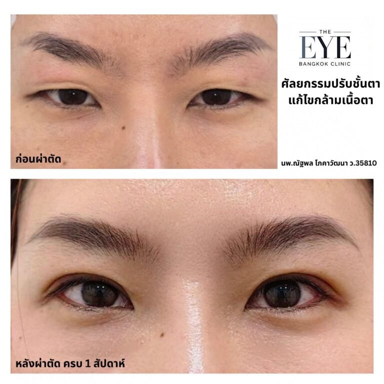 รีวิวผ่าตัดกล้ามเนื้อตาอ่อนแรงและปรับชั้นตา (Ptosis repair) ก่อนและหลังผ่าตัด 1 สัปดาห์ โดยจักษุแพทย์เฉพาะทาง The Eye Bangkok Clinic