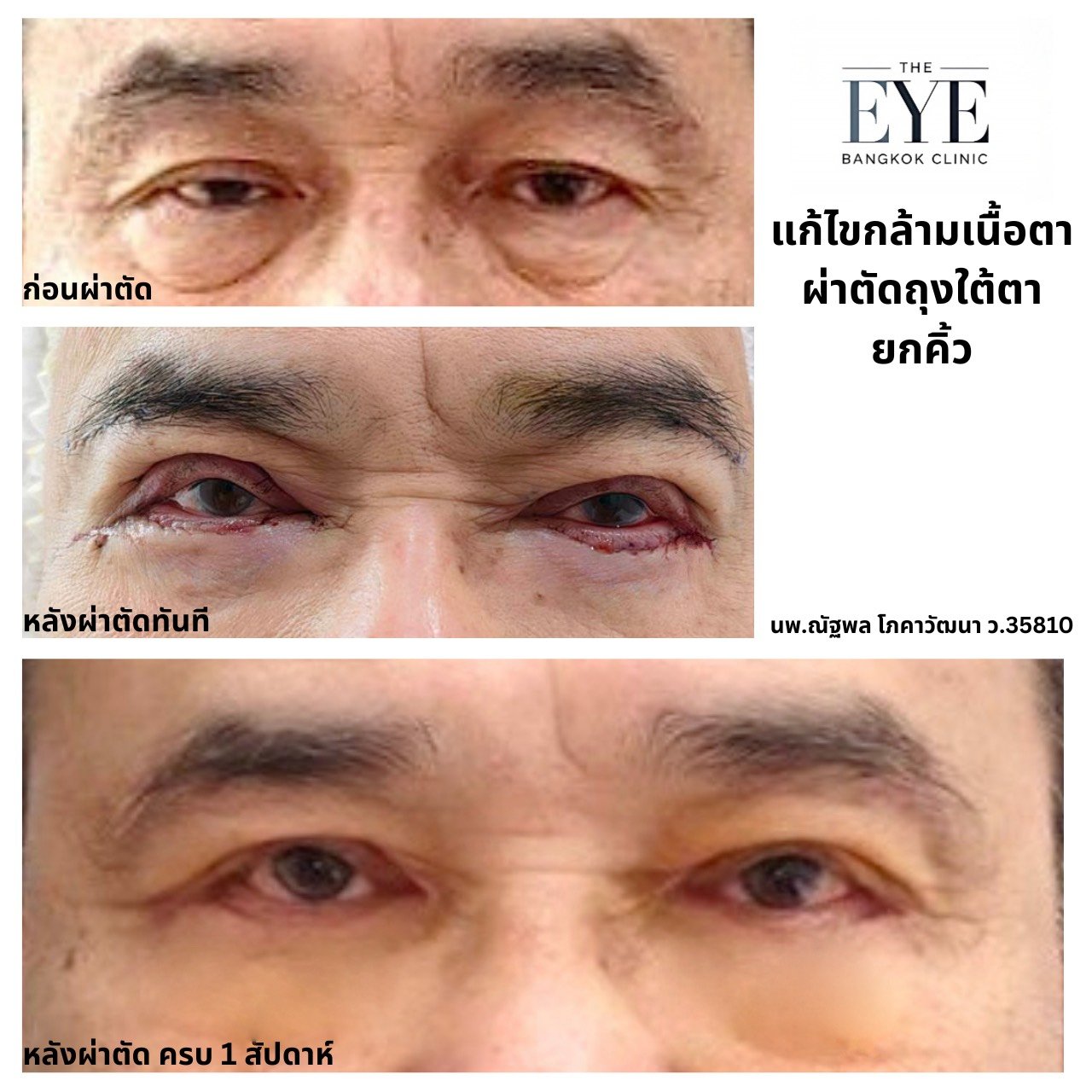 เคสผ่าตัดแก้ไขกล้ามเนื้อตาอ่อนแรง (ptosis repair) ร่วมกับผ่าตัดถุงใต้ตาและยกคิ้ว ในผู้ชายที่มีภาวะตาตกต้องเงยหน้า ก่อนและหลังผ่าตัด 1 สัปดาห์ โดยจักษุแพทย์เฉพาะทาง The Eye Bangkok Clinic