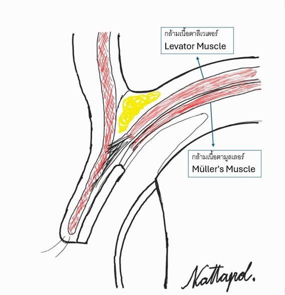 Levator muscle and Muller muscle