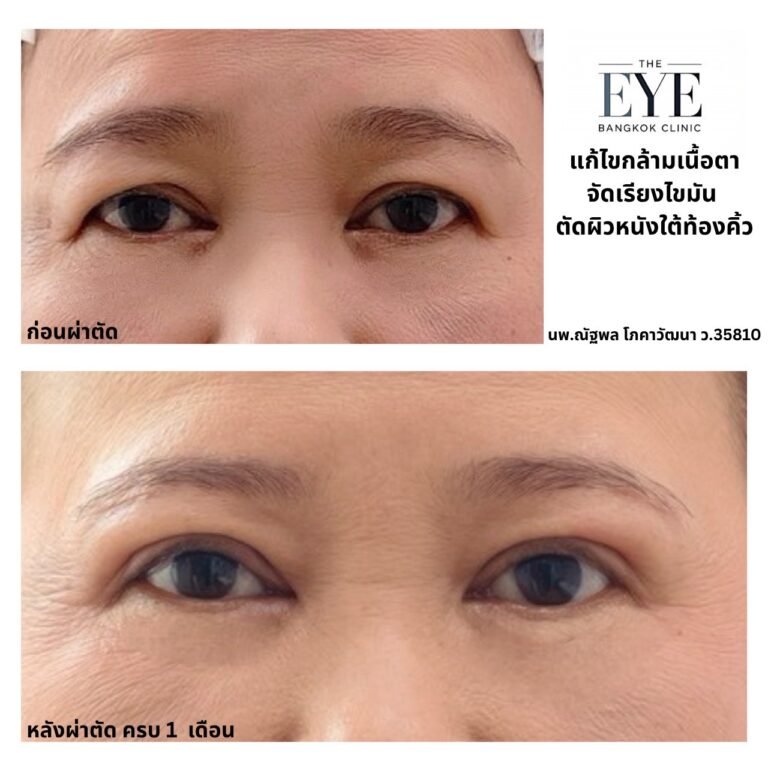 ผ่าตัดใต้ท้องคิ้ว เหมาะกับใคร แผลซ่อนตรงไหน ทำไมถึงเป็นที่นิยม